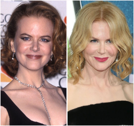 Plastic Surgery Kidman